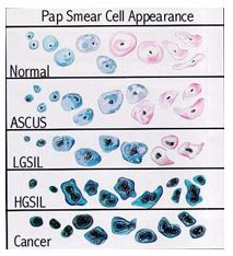 Pap Smears: When Yours Is Slightly Abnormal .
